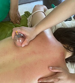 Techniques de relâchement myofascial et de ventouses