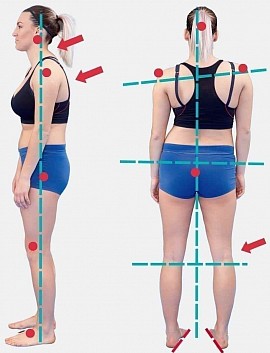 Pain-Avoidance Postures and Trigger Point Therapy