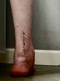 Learn how to apply myofasial release for scar tissue