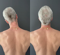 Photo depicts a person requiring myofascial release for the neck, untreated, it may lead to cervical hernia
