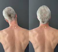 Questo sintomo potrebbe portare a un'ernia cervicale in futuro. Affrontiamo il problema di come evitarlo utilizzando tecniche di rilascio miofasciale dinamico